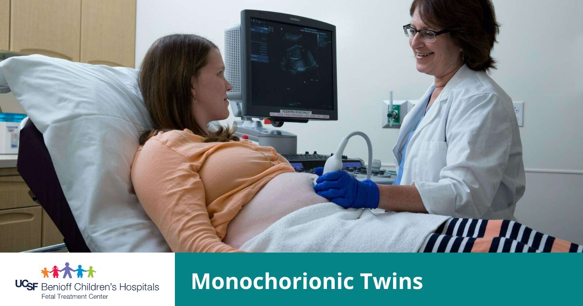 Monochorionic Twins